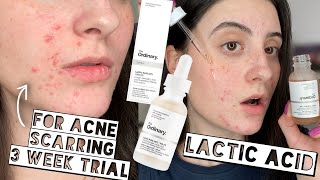 TESTING THE ORDINARY LACTIC ACID 10  HA ON ACNE SCARS FOR 3 WEEKS  Sensitive  Dry Skin [upl. by Aimehs]