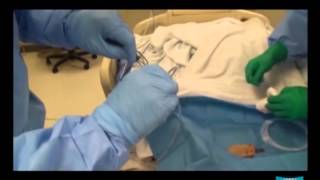 Percutaneous Endoscopic Gastrostomy pull method and Jejunal Extension Tube Placement [upl. by Nilok]