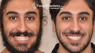 Underbite Crooked Teeth Crossbite Correction with VENLAY® Bite Restoration [upl. by Hainahpez]