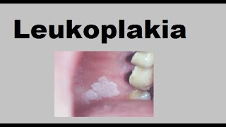 Leukoplakia [upl. by Prosser373]