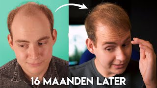 16 MAANDEN LATER  HAARTRANSPLANTATIE UPDATE 6 [upl. by Ramso446]