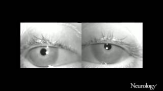 Bilateral INO Unusual patterns of saccadic intrusions [upl. by Swope]