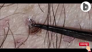 Ingrown Hair Video [upl. by Anecuza510]