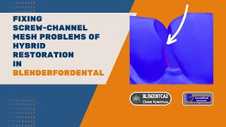 Fix screwchannel mesh problem of hybrid restorations from other softwares in blenderfordental [upl. by Ttenaj]