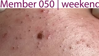 Acne Treatment Huong Da Nang 050  weekend  2023 [upl. by Ellehcor982]