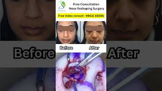 Female Rhinoplasty Before amp After Shorts treatment hospital nosesurgery shorts [upl. by Aynnek]