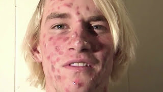 ZIT FACE GUY  PIMPLE ACNE EXPLOSION [upl. by Delgado213]