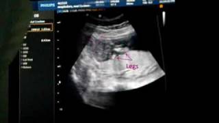 Ultrasound 17 weeks  Its A Girl [upl. by Adnov205]