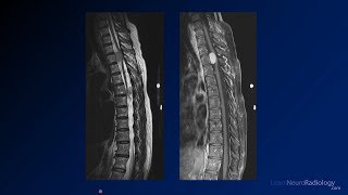 Neuroradiology board review 2 case 16 [upl. by Merril]