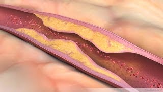 What is Atherosclerosis [upl. by Yrrol]