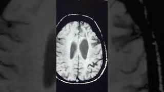 Significance of SWI  Superficial siderosis [upl. by Thornburg]