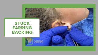 STUCK  Earring Backing Removal  Dr Derm [upl. by Udela79]