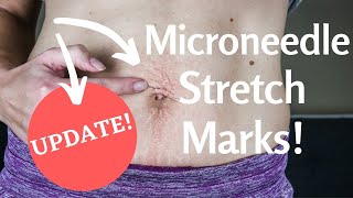 Microneedling STRETCH MARKS  Microneedling Stomach [upl. by Kyte541]