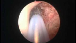 Colloid cyst endoscopy [upl. by Divadnhoj513]