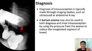 Intussusception Explained A Comprehensive Guide for Nursing and Midwifery Students [upl. by Jem158]