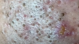 Blackheads amp Whiteheads Satisfying Removal 0035 [upl. by Donnell409]