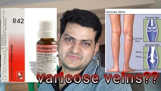 Homeopathic medicine for varicose veins explain [upl. by Asiuqram]