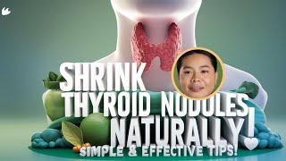 Thyroid Nodules  Causes And Natural Ways To Shrink Thyroid Nodules Hypothyroidism  Thyroid [upl. by Anirba]