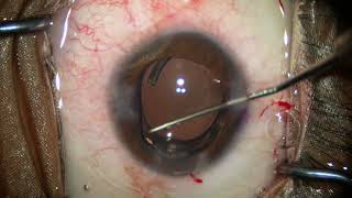 Case of Traumatic cataract with ZD with Traumatic Mydriasis managed with Phaco with pupilloplasty [upl. by Trust616]