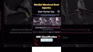 Fig 1B25 MRI Classification of Posterior Medial Meniscal Root Injuries [upl. by Ttelrahc472]