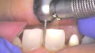 1 DR GERARD CUOMO 34 Porcelain Veneer Crown Restoration Deep Overbite Case [upl. by Gee]