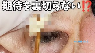 【耳掃除】104 耳かき 〜両耳バージョンまた右耳から……〜 earwax [upl. by Maribeth]