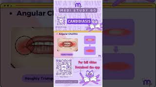 Angular Cheilitis  Oral Medicine  Medi Study Go [upl. by Tonnie]