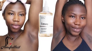 The Ordinary Glycolic Acid 7 Toning Solution to Lighten and Get Rid Of Dark Armpits [upl. by Spector]